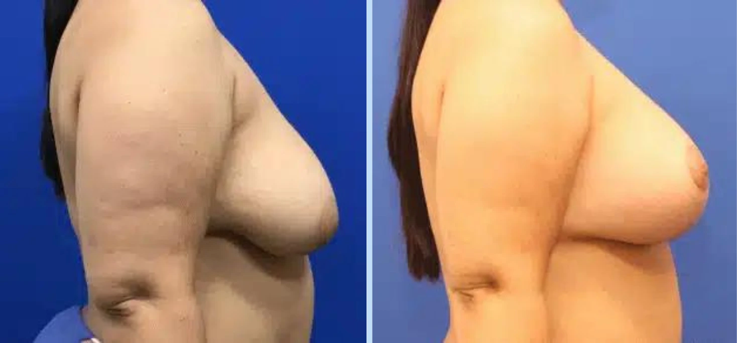 Breast Lift Before & After - Case 6